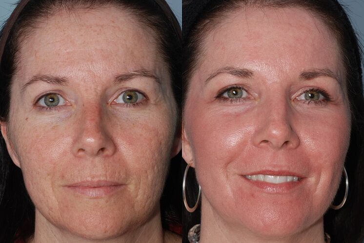 before and after material skin rejuvenation