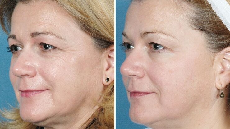 photos before and after material skin rejuvenation
